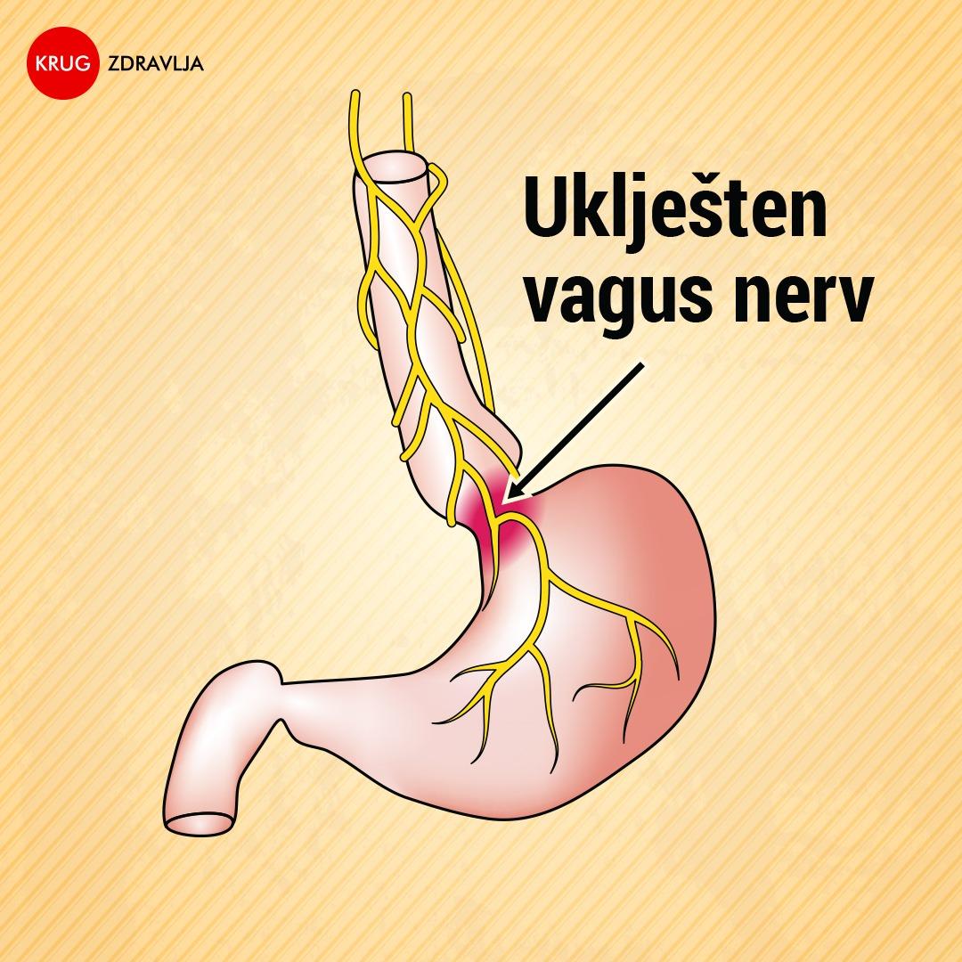 priklješten vagus nerv