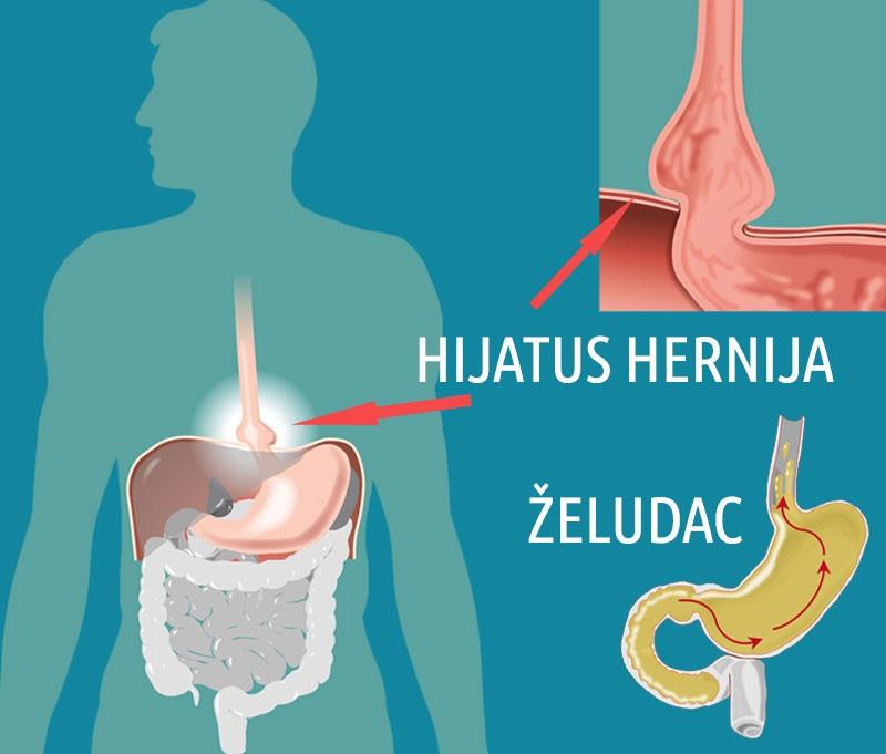 grafički prikaz kako izgleda kila na želucu i gde se nalazi