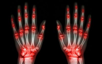 Moj artritis i kako ga mučim