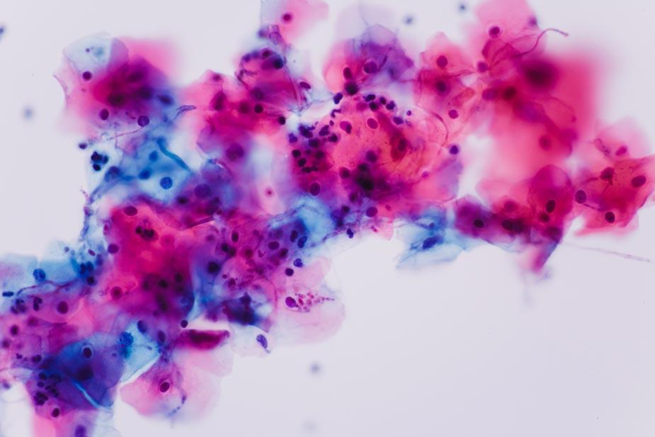 kandida i kandidijaza viđena pod mikroskopom