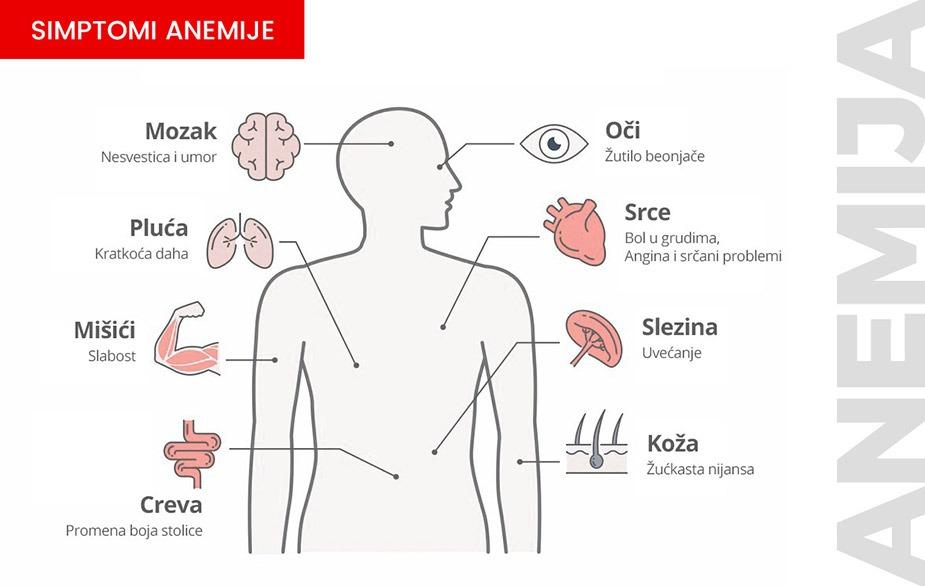 grafički prikaz na kome se vide simptomi anemije