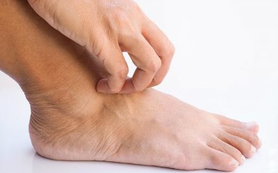 Atletsko stopalo – simptomi i lečenje