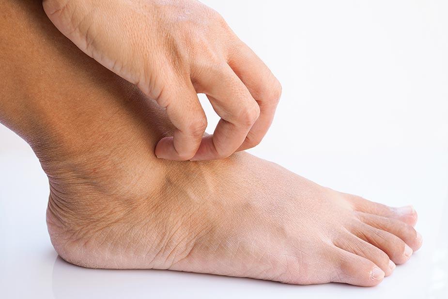 šaka koja češe stopalo - atletsko stopalo