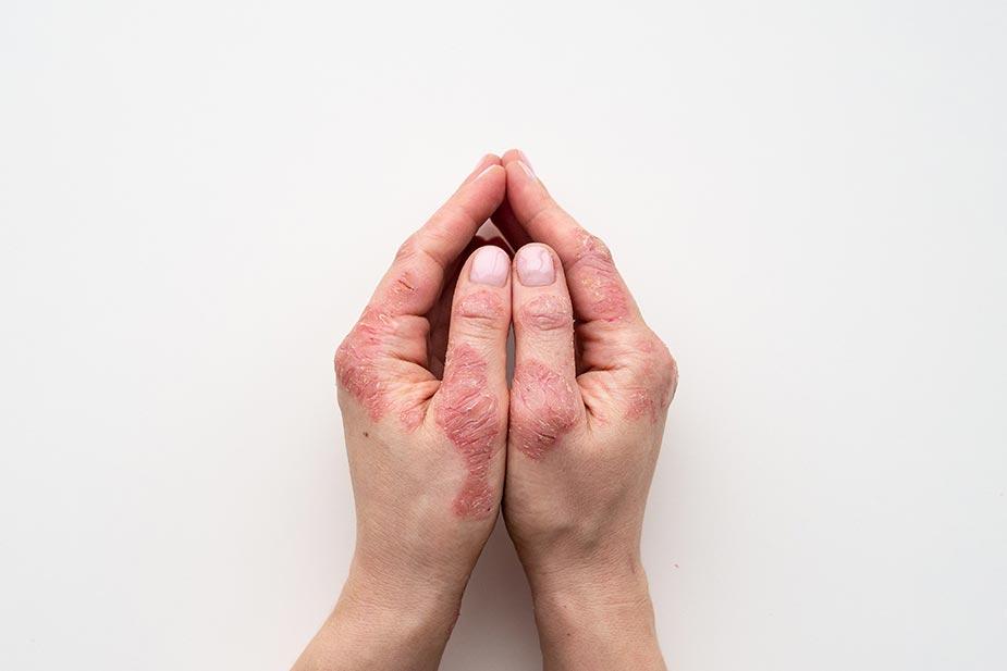 ruke napadnute psorijazom