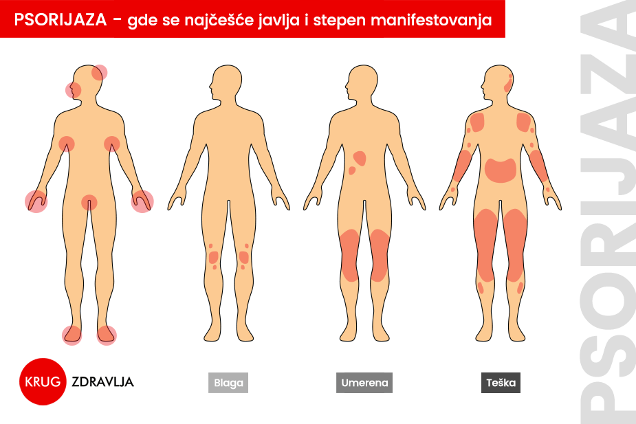 grafički prikaz gde se na telu najčešće pojavljuje psorijaza i stepeni težine bolesti