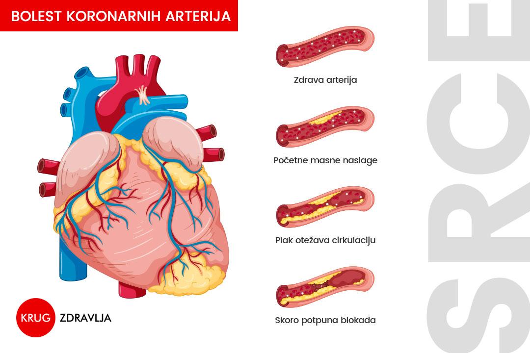 bolest koronarnih arterija