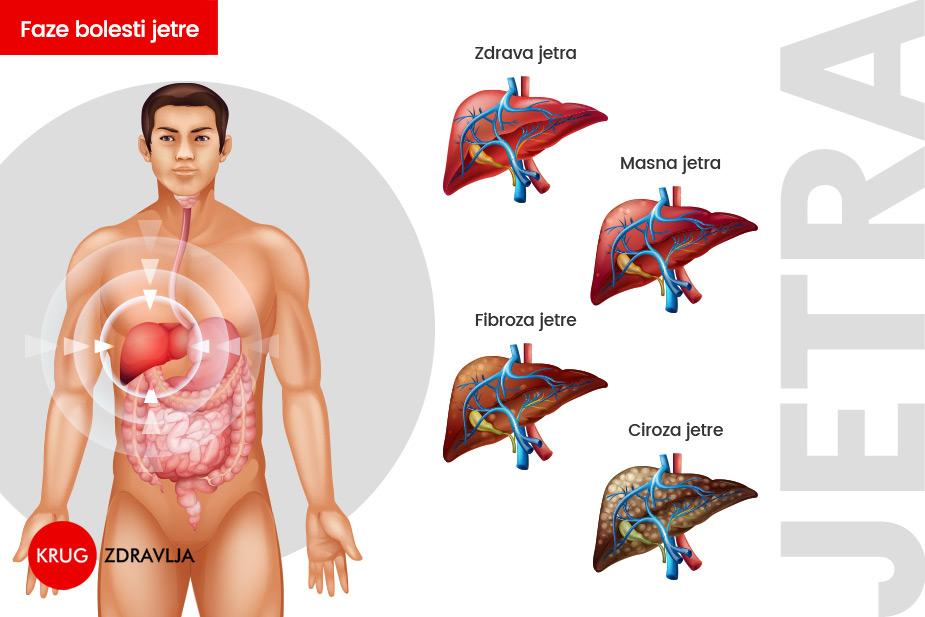 grafički prikaz faza bolesti jetre