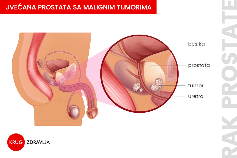 Rak prostate - grafički prikaz
