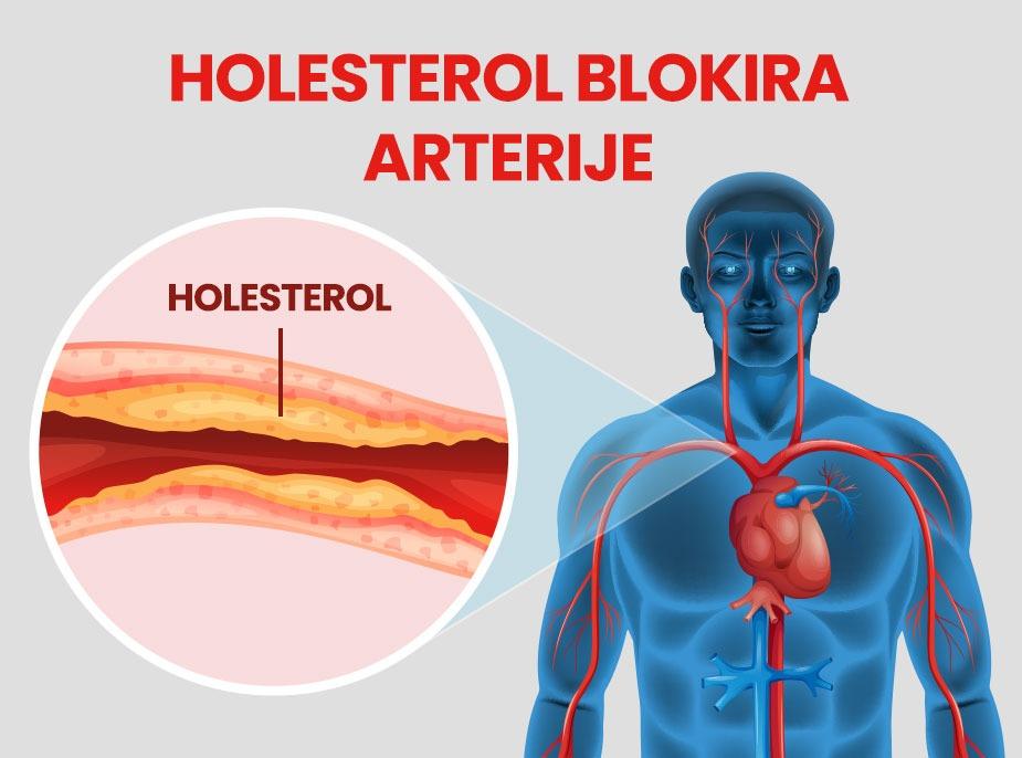 grafički prikaz kako holesterol utiče na začepljenje arterija