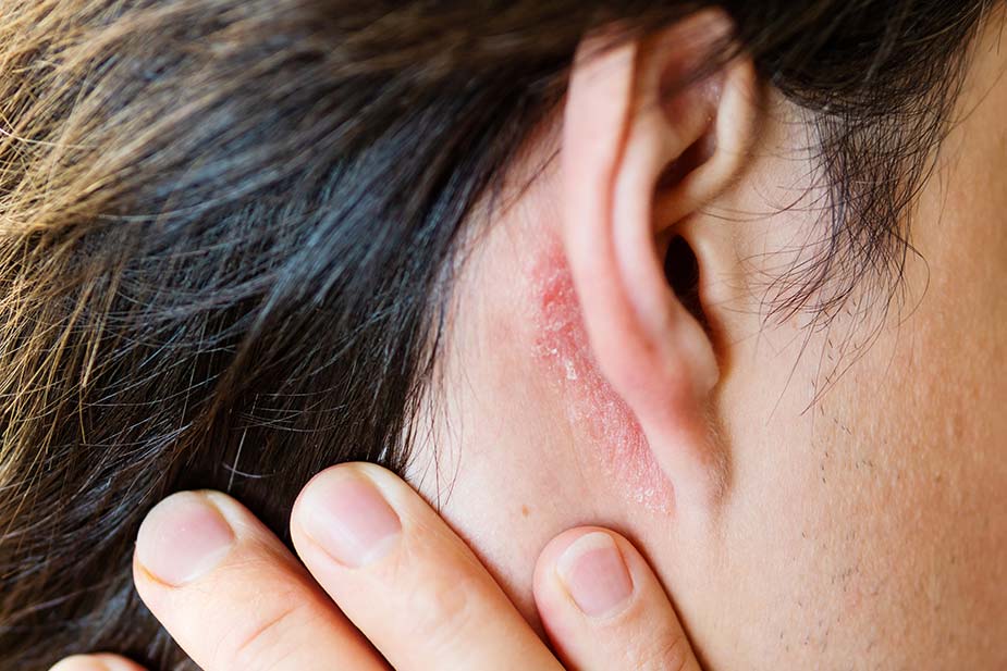 osoba sa zadignutom kosom pokazuje gljivice na koži iza uha