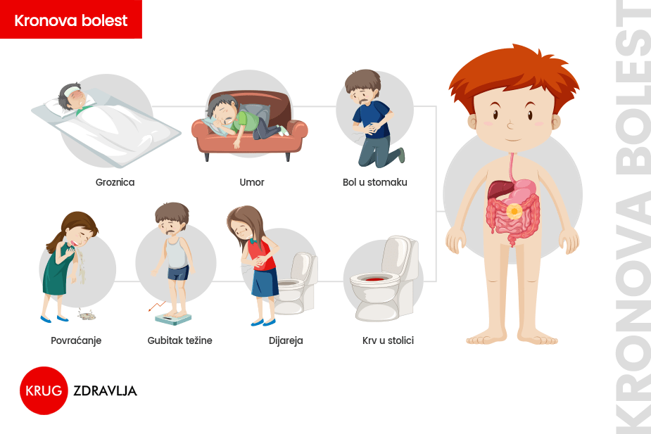 Kronova bolest simptomi
