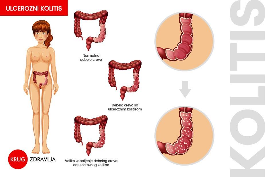 Ulcerozni kolitis - ilustracija težene bolesti