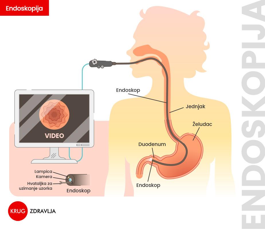 Endoskopski pregled želuca