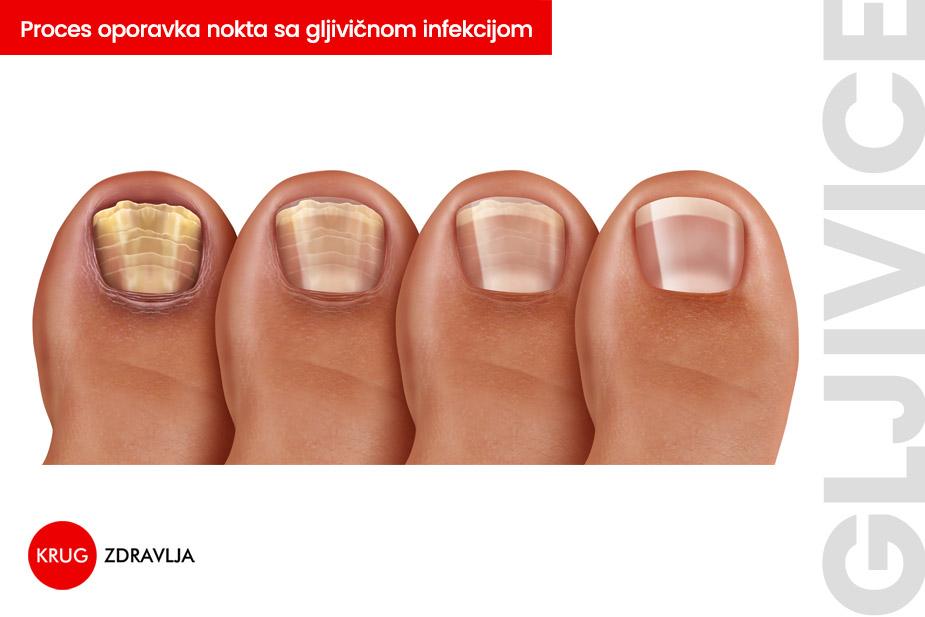 lečenje gljivica na noktima nogu