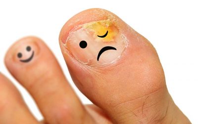 Gljivice na noktima nogu