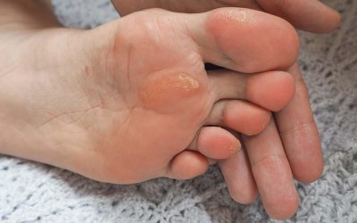 Kurje oko i žuljevi na stopalima