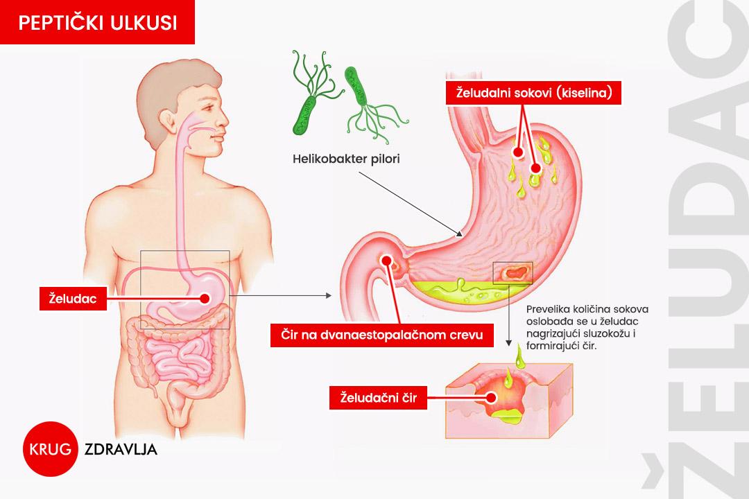 Grafički prikaz želuca i lokalizacija čireva