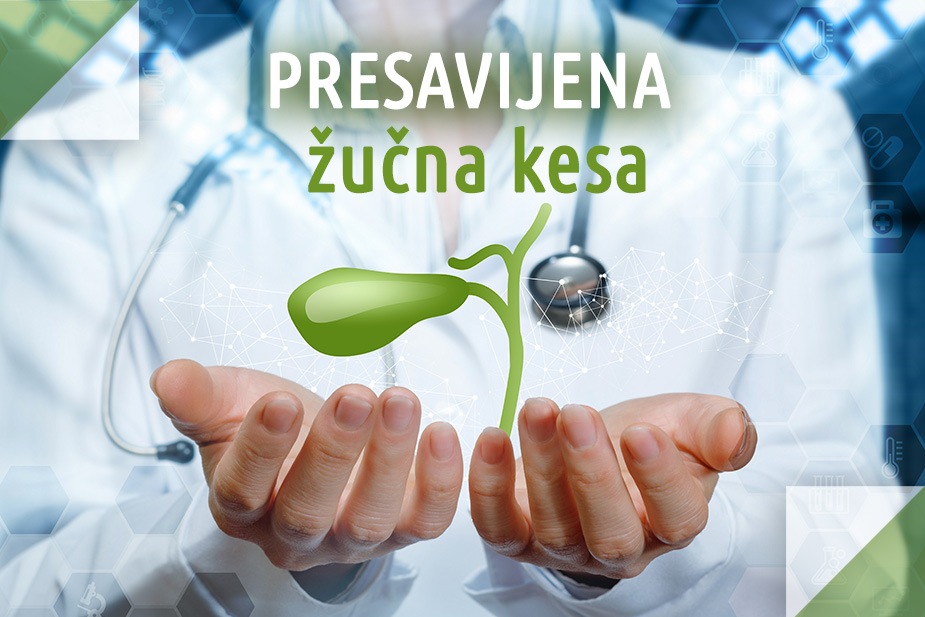 Presavijena žučna kesa
