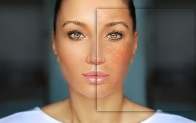 Hiperpigmentacija kože tokom leta