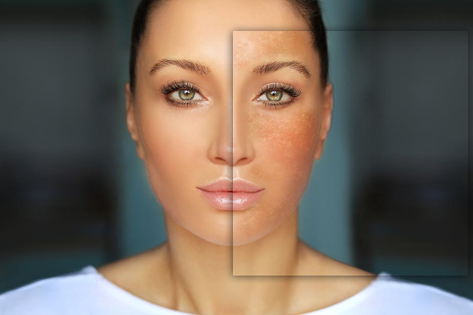 Hiperpigmentacija kože