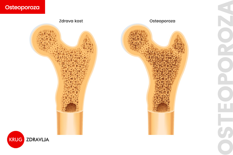 Prikaz zdrave kosti i kosti sa osteporozom