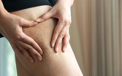 Strije i kako ih tretirati