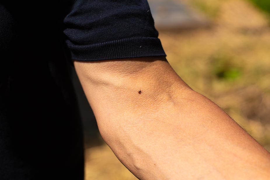 Krpelj na pregibu lakta - krpelji