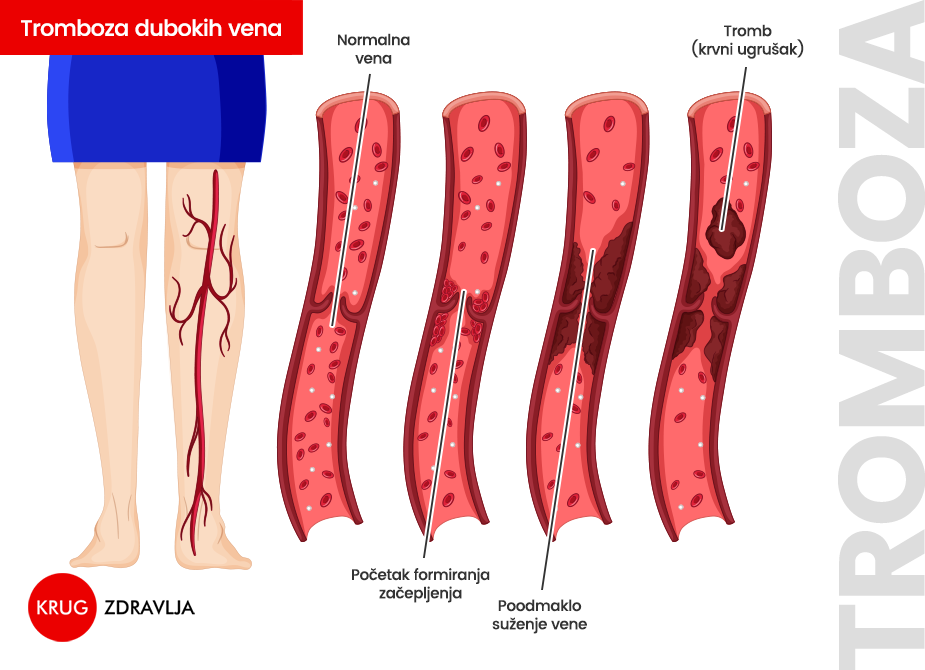 Grafički prikaz progresivnog začepljenja krvnog suda