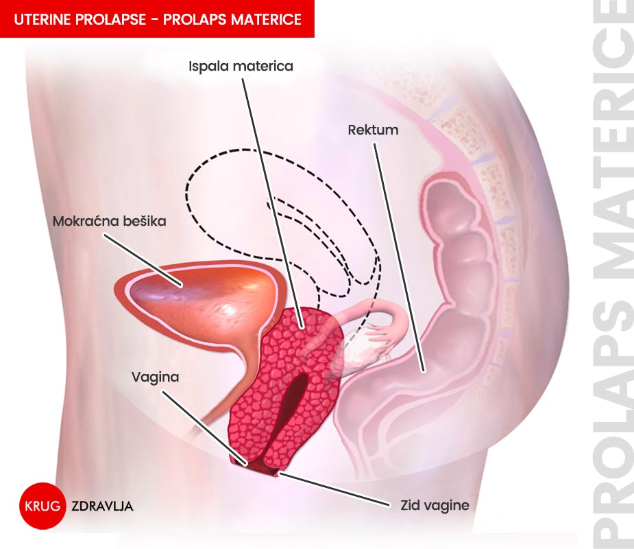 Shema prolapsa materice