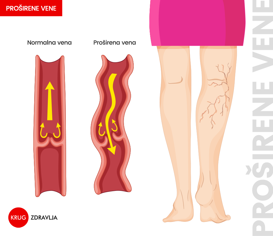 Šematski prikaz proširenih vena na nogama