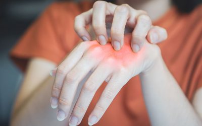 Atopijski dermatitis – Ekcem