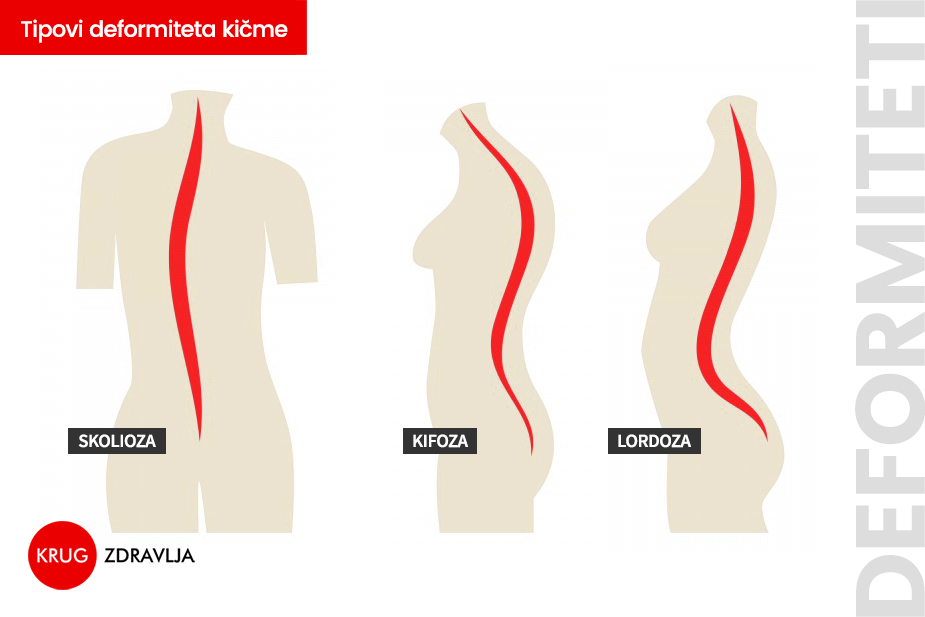 Tipovi deformiteta kičme