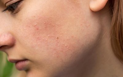 Bubuljice od sunca i kako se izboriti sa njima